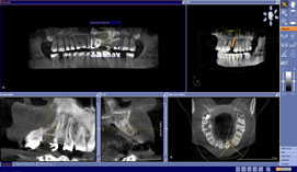 Digitale 3-D-Implantatplanung